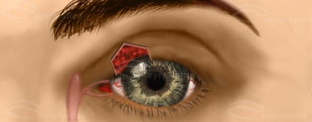 Marking the pentagonal wedge of upper eyelid to be removed