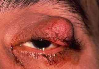 Sebaceous gland carcinoma of the upper eyelid resembling a chalazion
