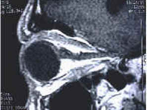 Sagittal view of the orbit showing depth and apex