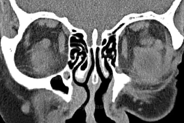 Coronal CT showing a well-defined left orbital cavernous hemangioma