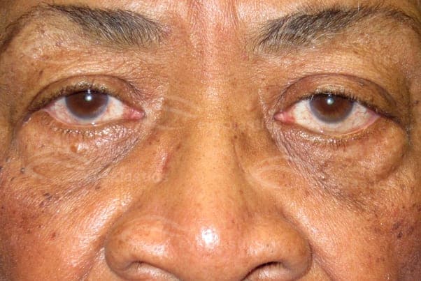 Left proptosis and lower-eyelid retraction from an orbital cavernous hemangioma