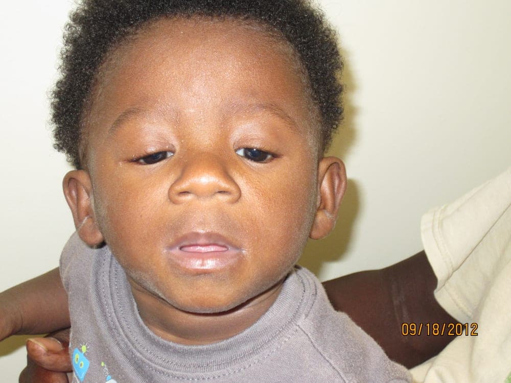 Congenital ptosis with a poorly formed eyelid crease