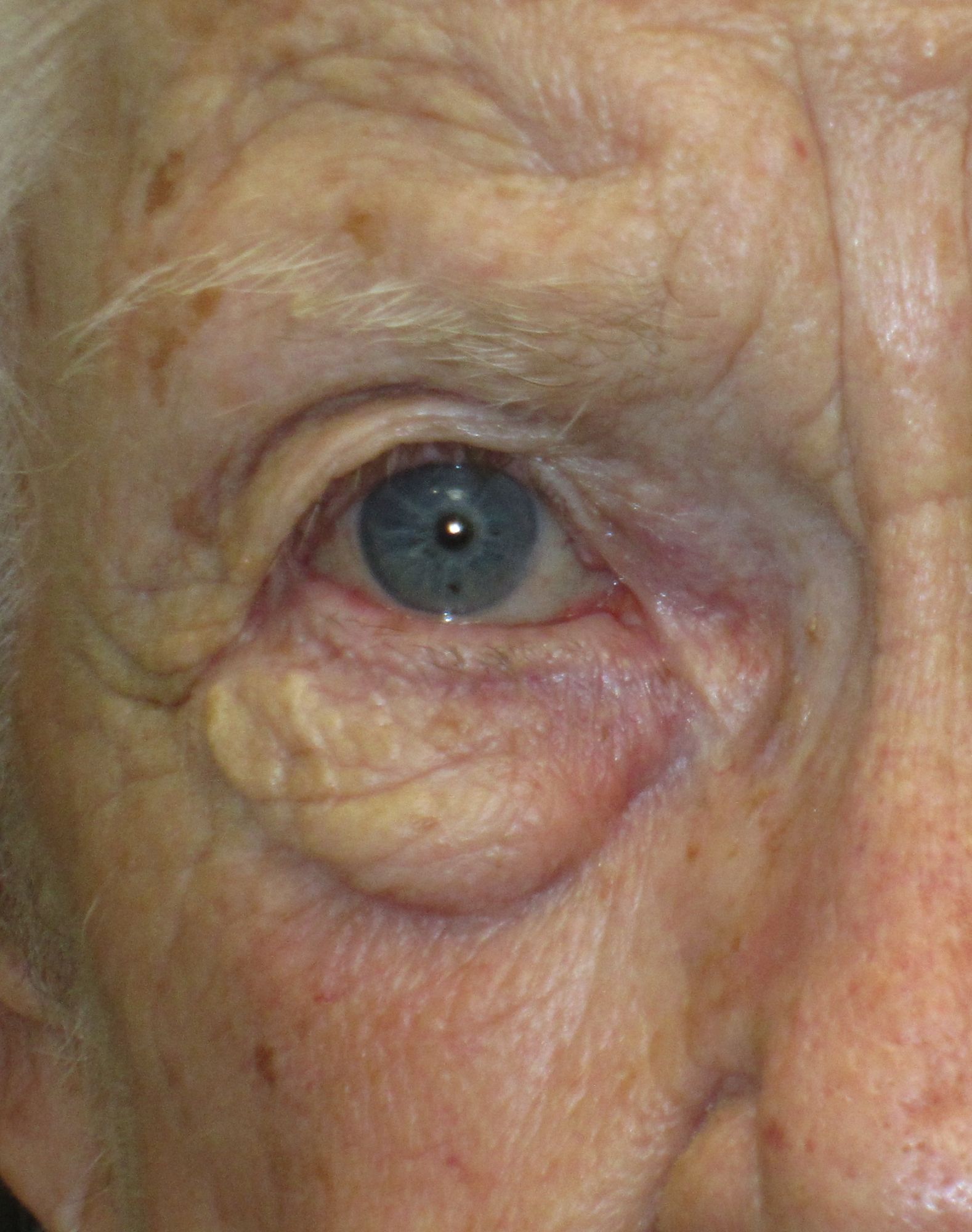 Herniated orbital fat — true under-eye bags above the orbital rim
